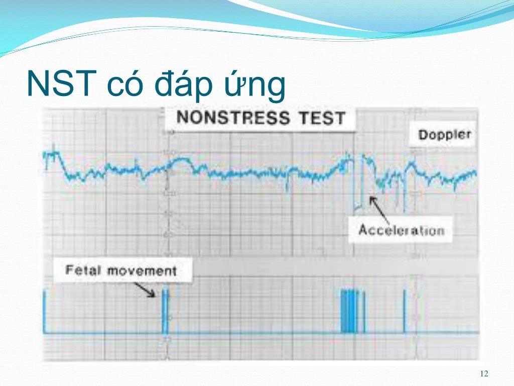 Cách đọc kết quả non-stress test (NST)