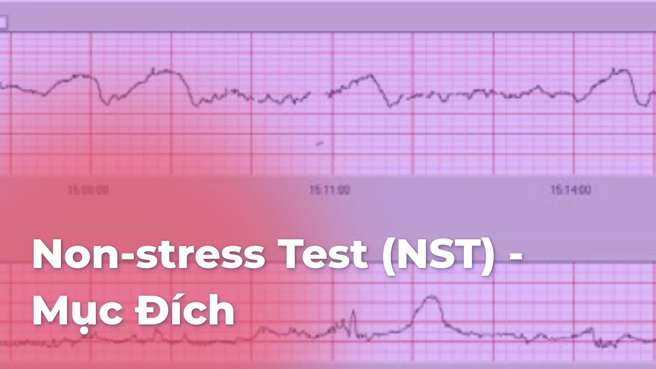 Non-stress Test (NST) – Mục Đích & Quy Trình Thực Hiện
